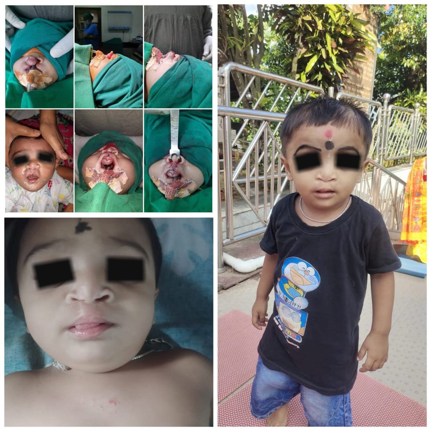 bilateral cleft lip repair